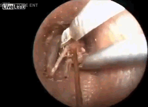Гифка Извлечение насекомого из уха человека
