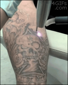 Гифка Лазерное удаление татуировки