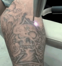 Гифка Лазерное удаление татуировок