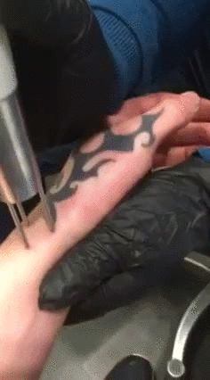 Гифка Удаление татуировки